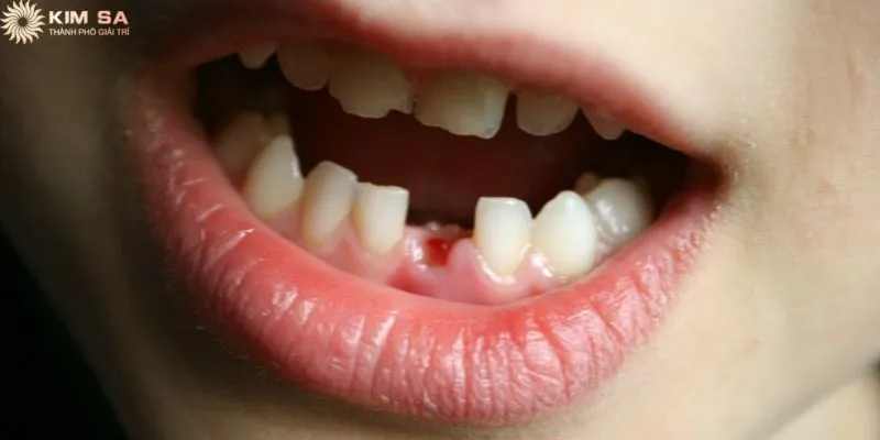 Nằm mơ thấy rụng răng đánh số gì thì trúng
